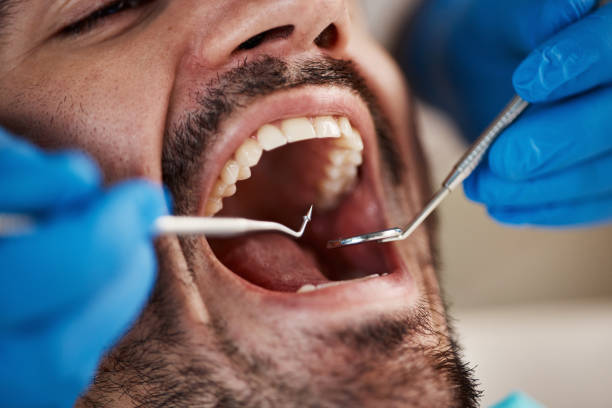 Best Emergency Tooth Extraction in Batesville, TX